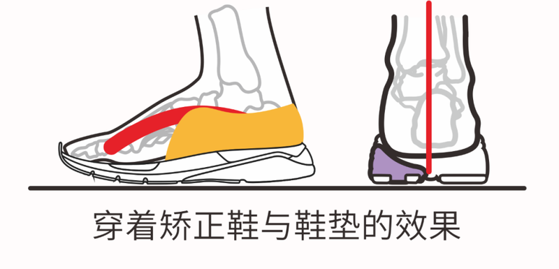 新学期新起点：矫正鞋助力孩子自信前行